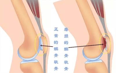 跑完步膝盖疼是怎么回事，全套缓解办法快速止疼 减肥 第2张